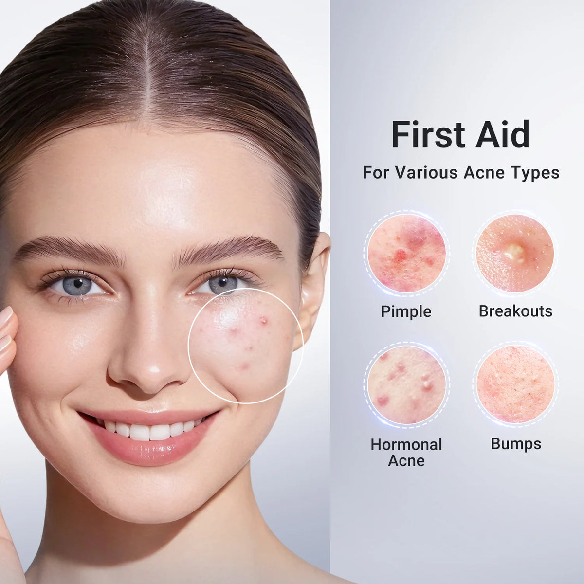 Acne Drying Lotion Plus (1.8% Encapsulated Salicylic Acid)