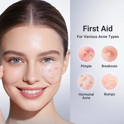 💧Acne Drying Lotion Plus (1.8% Encapsulated Salicylic Acid)