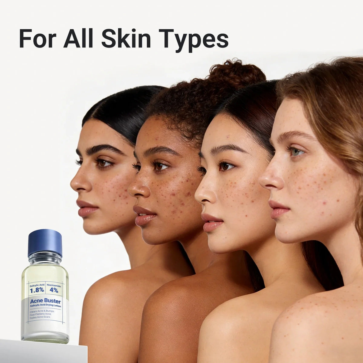 Acne Drying Lotion Plus (1.8% Encapsulated Salicylic Acid)