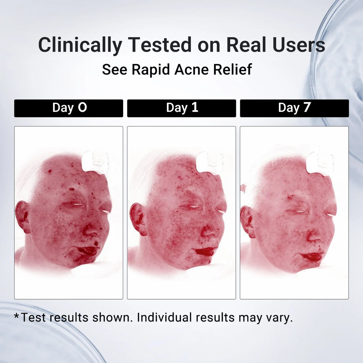 Acne Drying Lotion Plus (1.8% Encapsulated Salicylic Acid)