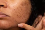 Visible dark spots on facial skin