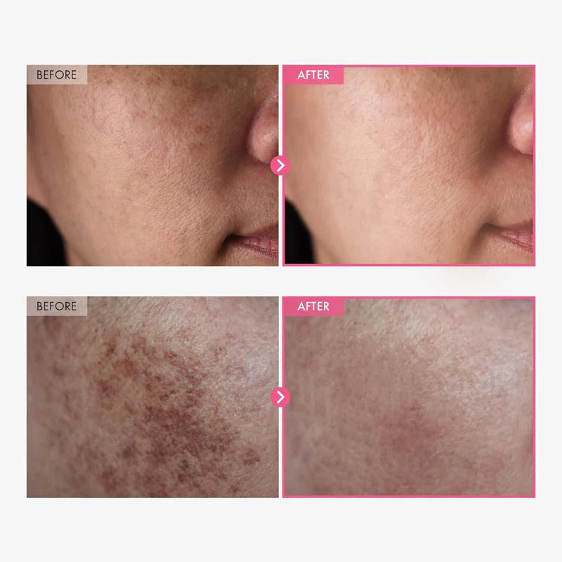 Arbutin 7% + Tranexamic Acid 4% Cream – LIMITED TIME OFFER