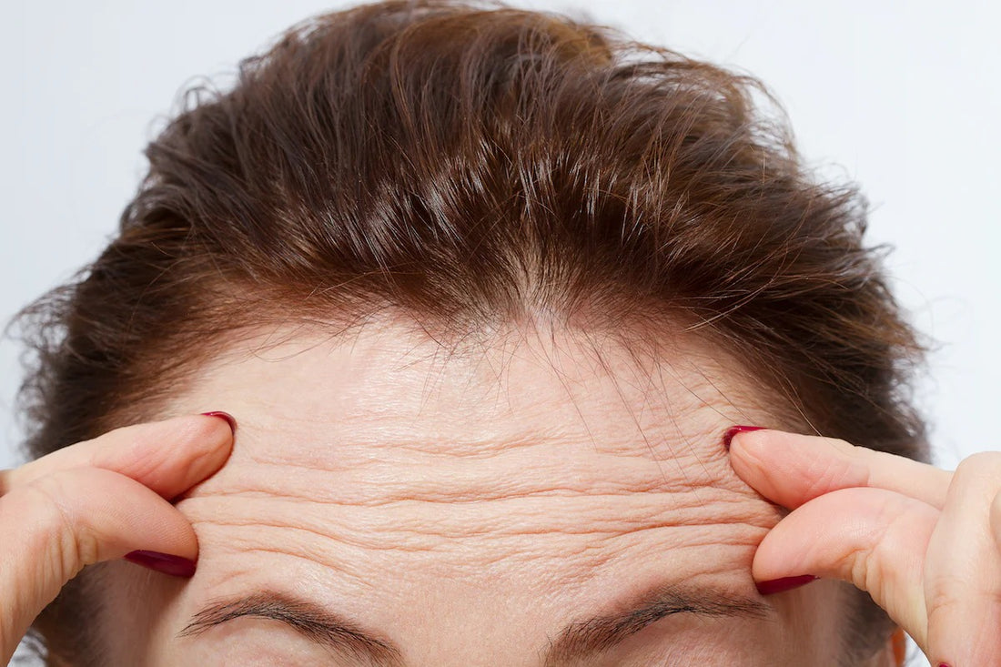Wrinkles and fine lines on forehead