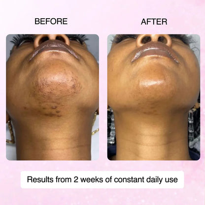 🌿100% Natural Cyperus Rotundus Skin Serum