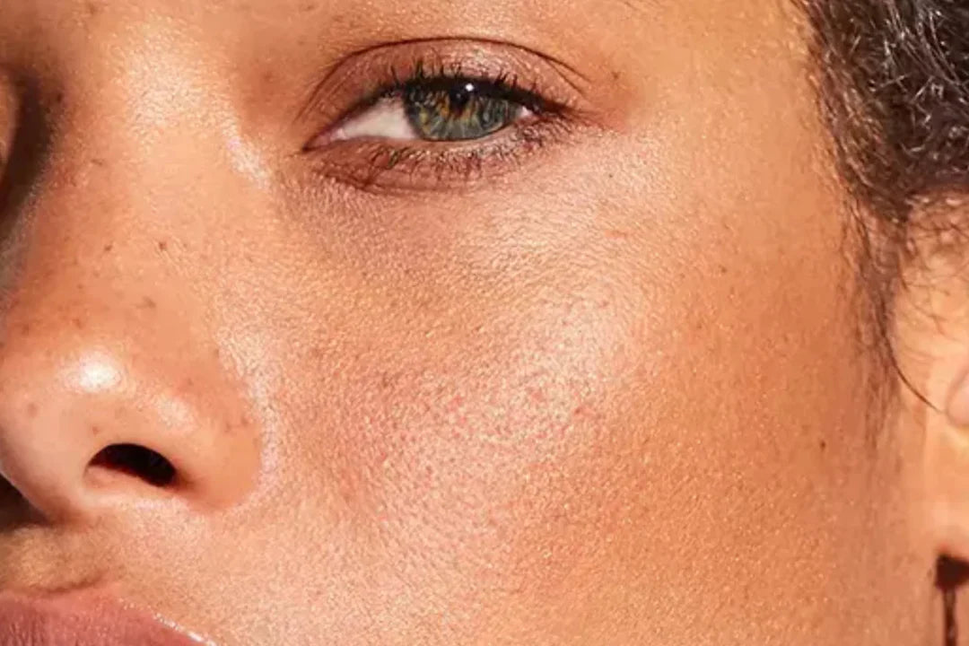 Uneven facial skin tone and texture